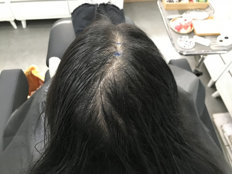 延世ミダインで頭皮を刺さったリアル体験談です