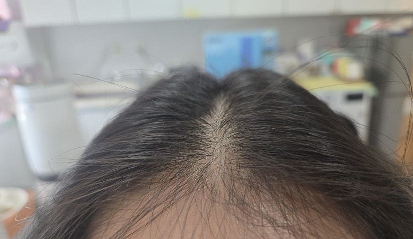 시술 전