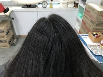 시술 후