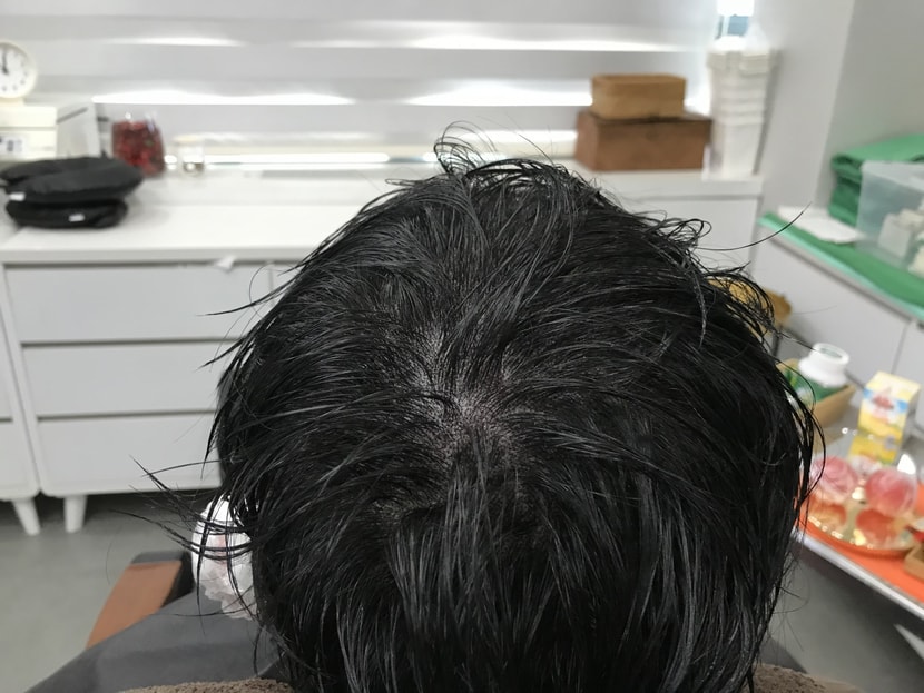 시술 후 물 묻힌사진