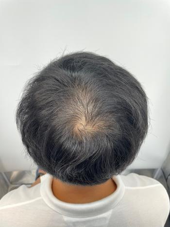 두피시술전