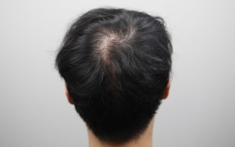 Hair loss that only gets empty on the kiln? A review of the satisfaction of the Monara scalp tattoo