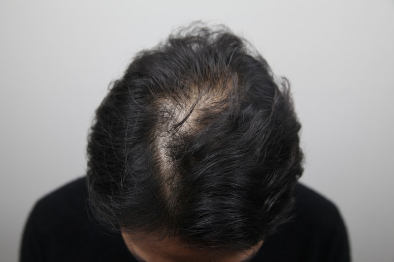 I get 4 scalp tattoos from Monara's dermatology department and leave a review