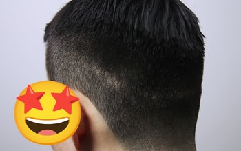 두피문신 전 절개 흉터