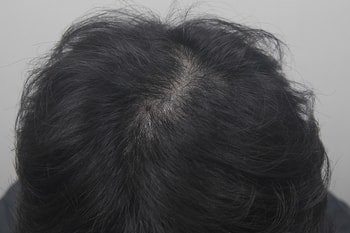 정수리 두피 문신 후