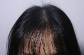 앞에서 봤을 때 두피문신 전후