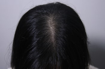 위에서 봤을 때 두피문신 전후