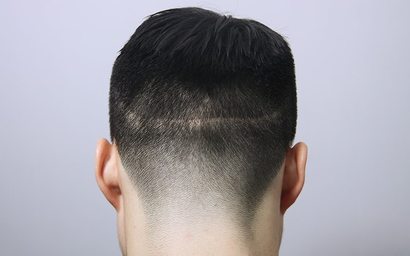 Cut scar! Perfectly covered with Mona scalp tattoos!