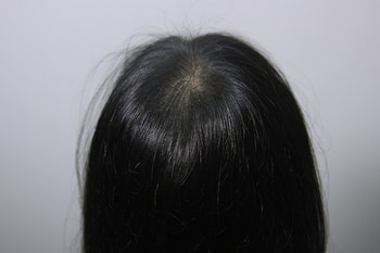 뒤에서 봤을 때 두피문신 전후