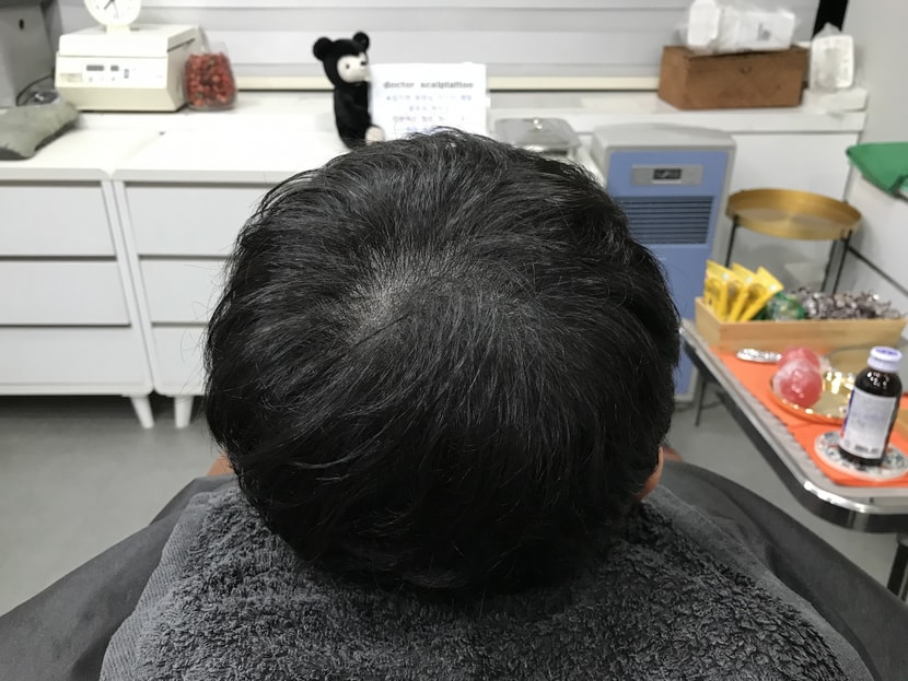 두피문신 후