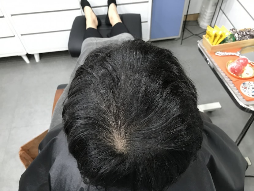 두피문신 전