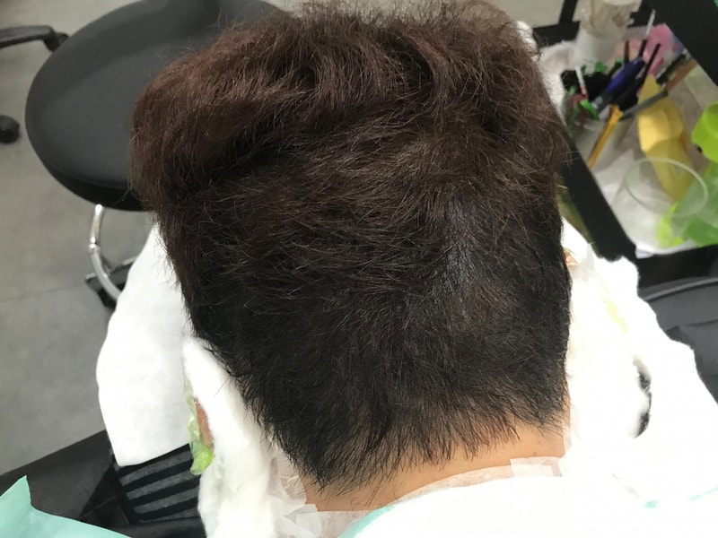 연세미다인 두피문신 2차 리터치 사진입니다