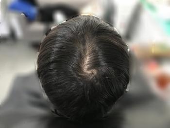시술 전(마른 머리)