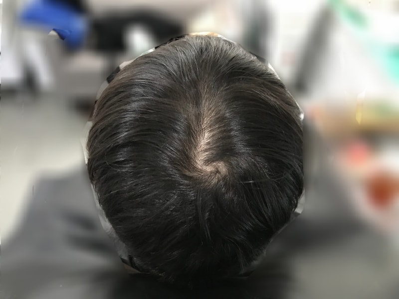 延世大学渐变圆点技术头皮纹身后期。
