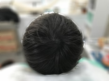리터치 시술 후(마른 머리)