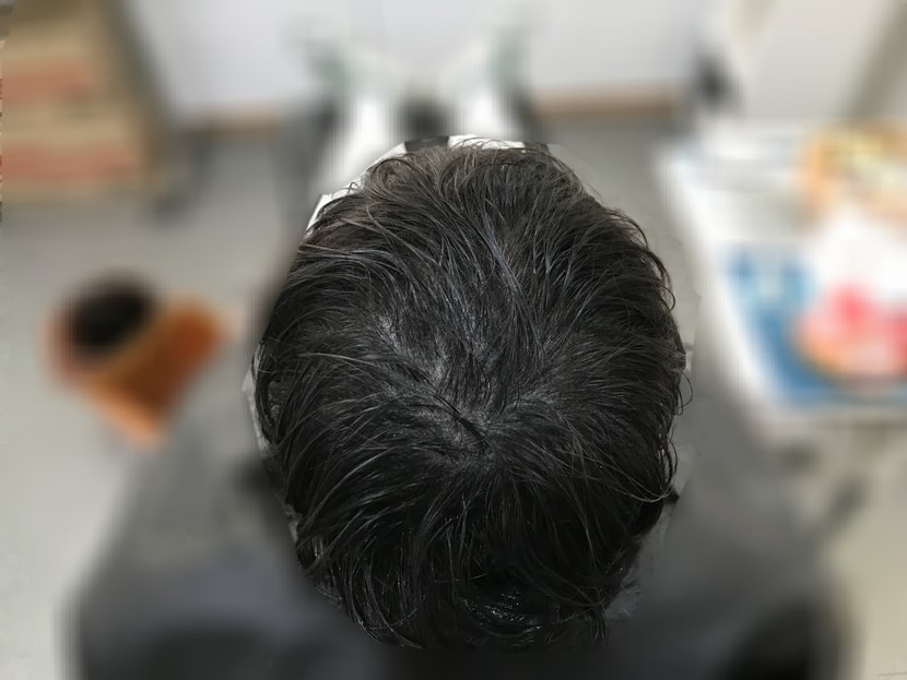 1차 시술 후(젖은 머리)