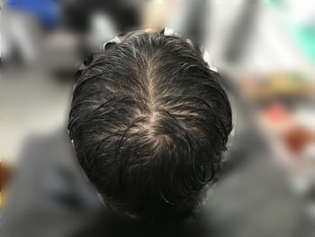 시술 전(젖은 머리)