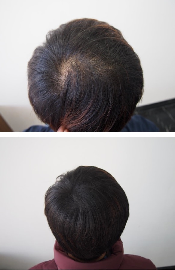 头顶头皮纹身一个月后记