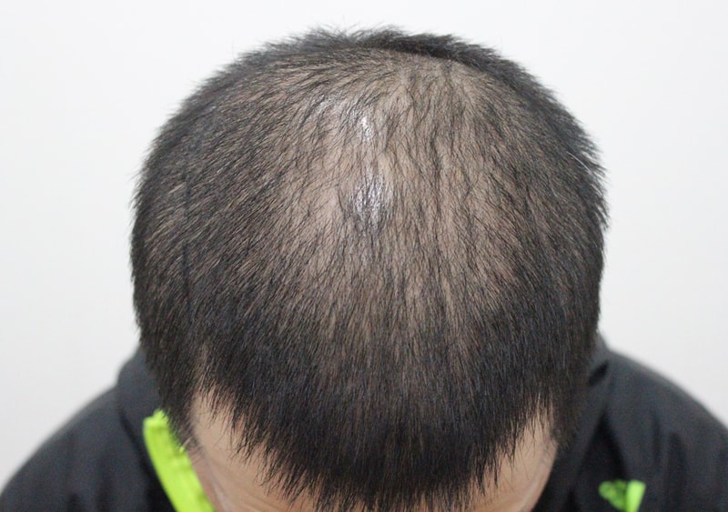 是男士30多岁头皮纹身后记。