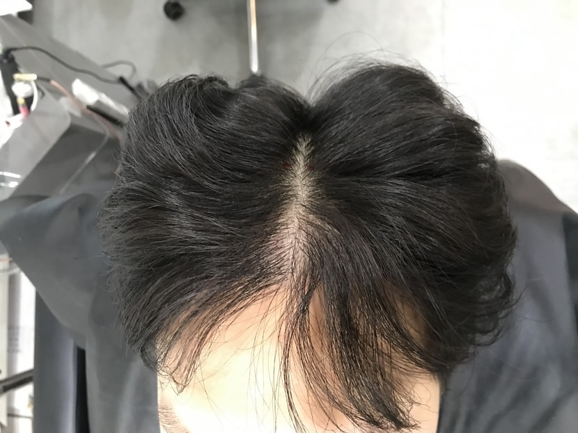시술전