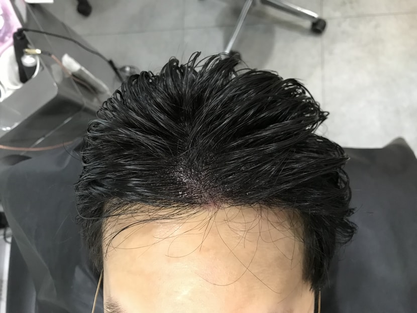 시술후