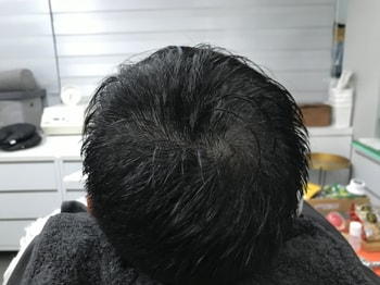 시술 후 물뭍힌 사진