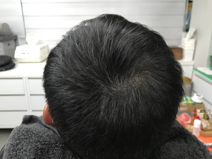시술 후