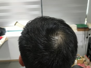 시술 전