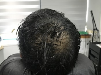 시술 전 물뭍힌 사진