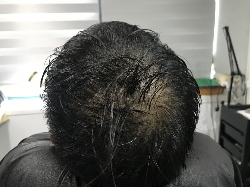 시술 전 물뭍힌 사진