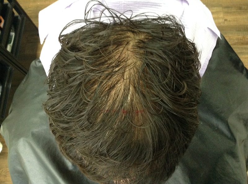 연세미다인 두피문신 후기