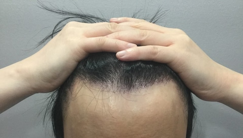 这是江南米开朗基兰头皮纹身后记。（纹身后发现脱发治疗效果）