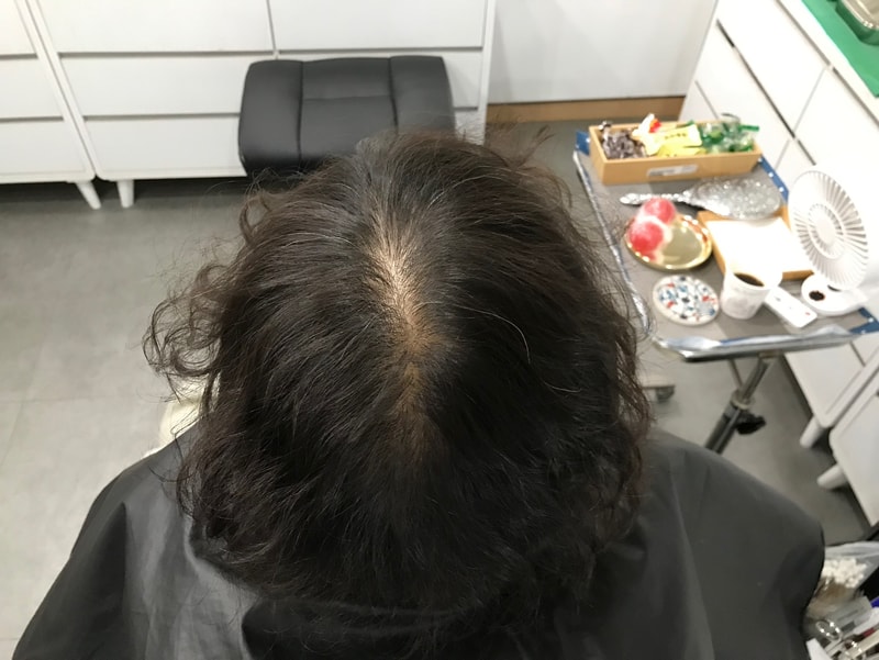 延世ミダインで頭皮を刺しました