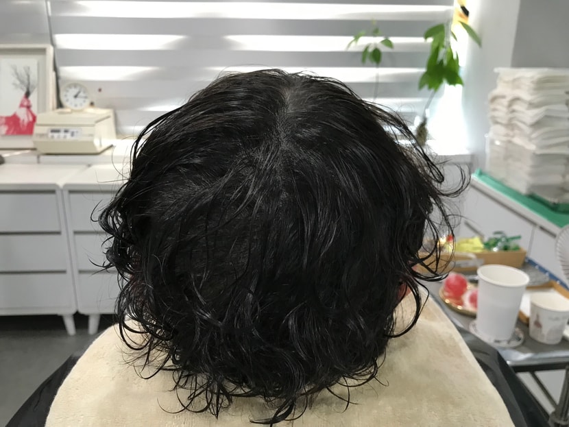시술후 사진