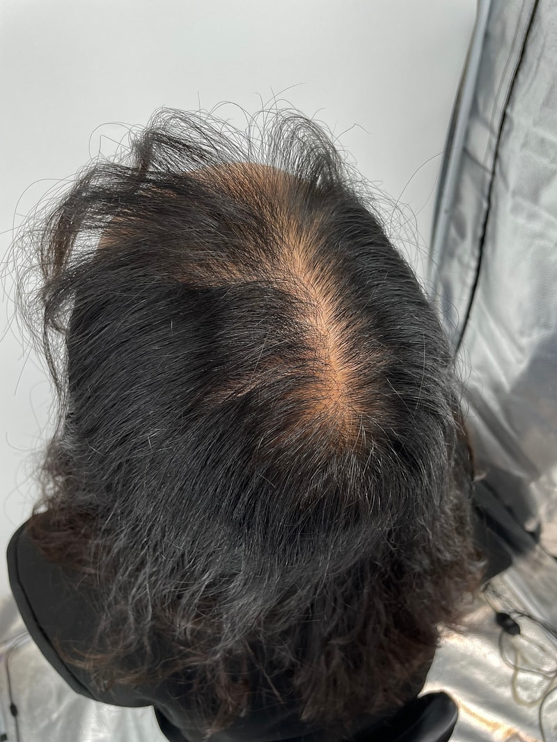 여성 두피문신 솔직하게 리뷰 적어봅니다