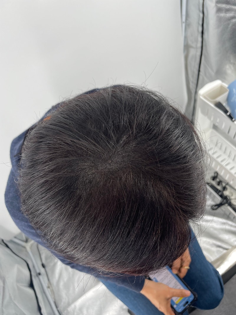 上传纹身江南新发顶/分发线第三次手术后记！！