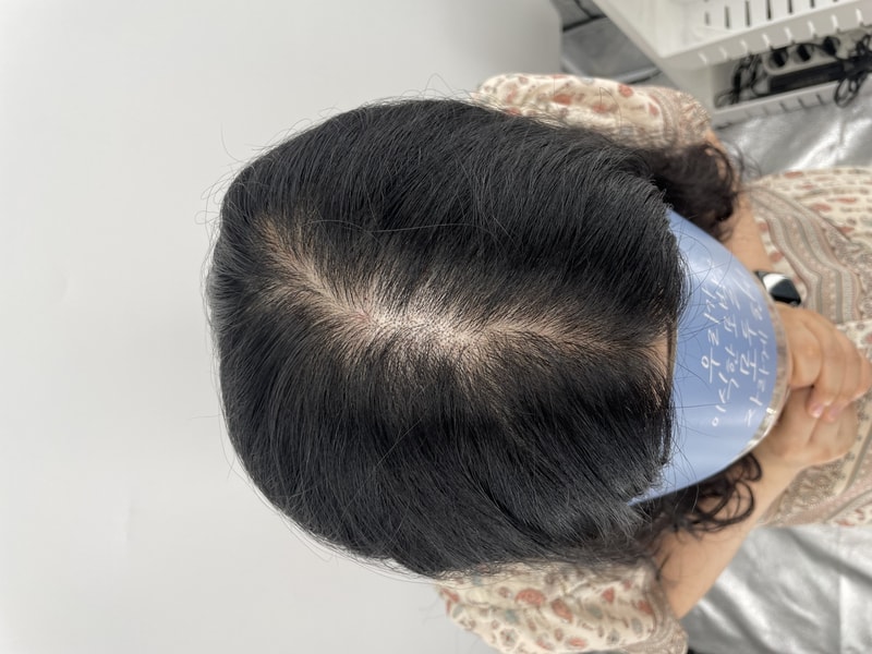 是NEWHAiR 植发中心头皮纹身后记！ 很自然！ 江南我们村的脱发医院推荐头皮纹身
