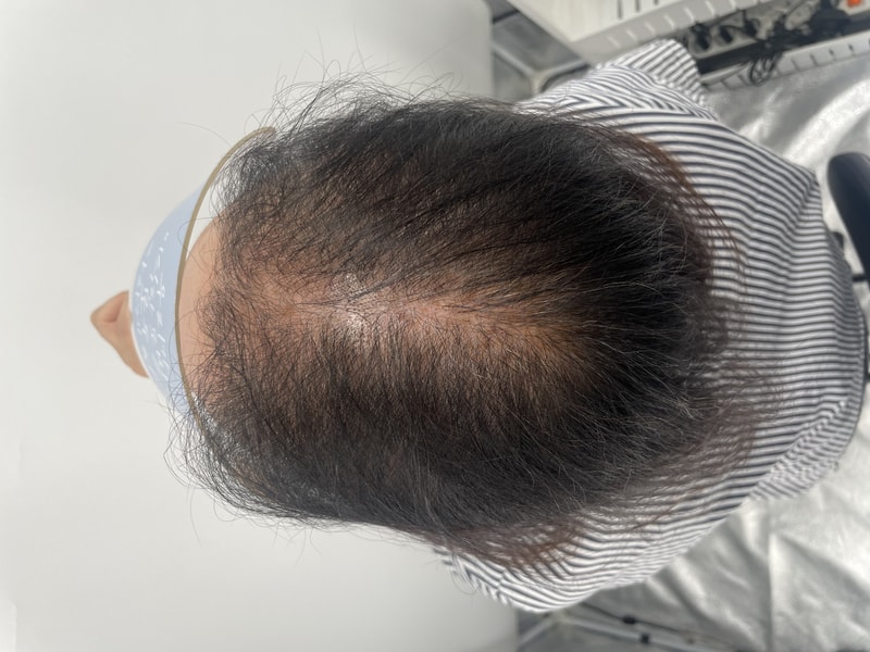 幸亏纹了头皮~ 江南New Hair的WIN老师 谢谢您 (著名我们村的脱发医院后记)