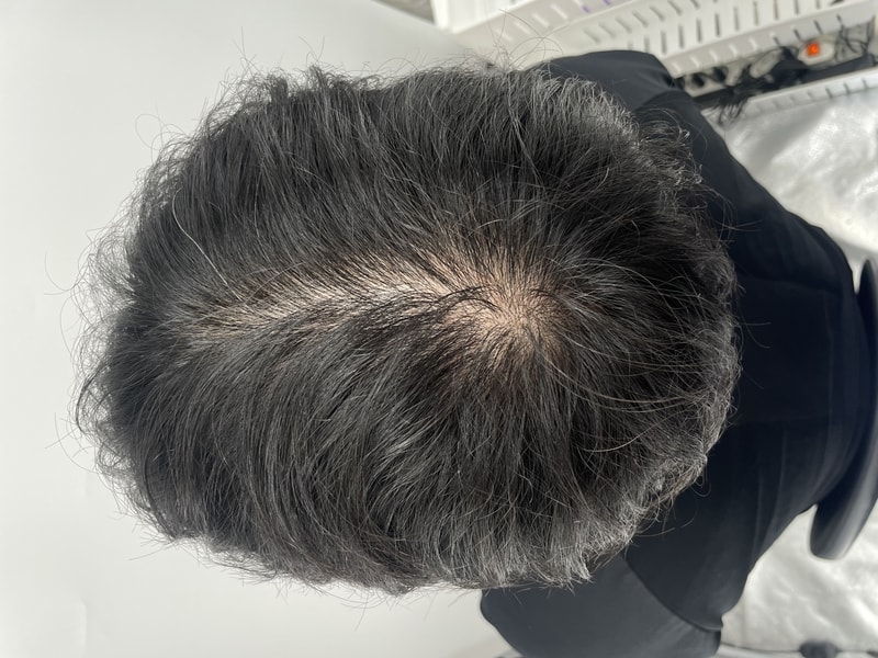 做了克服脱发的头皮纹身。 江南NEWHAiR 植发中心头皮纹身医院后期（积极推荐）