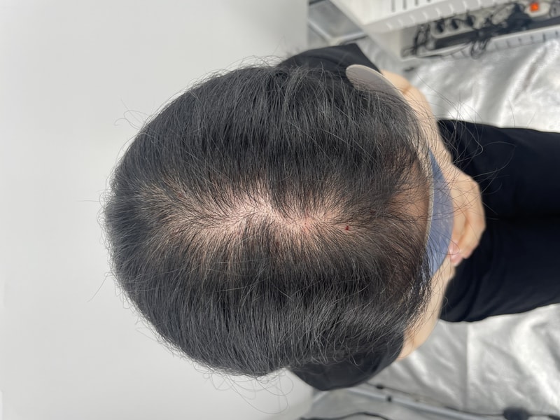 头皮纹身医院头皮纹身后记（江南新发型整形外怪后记）请务必收下！