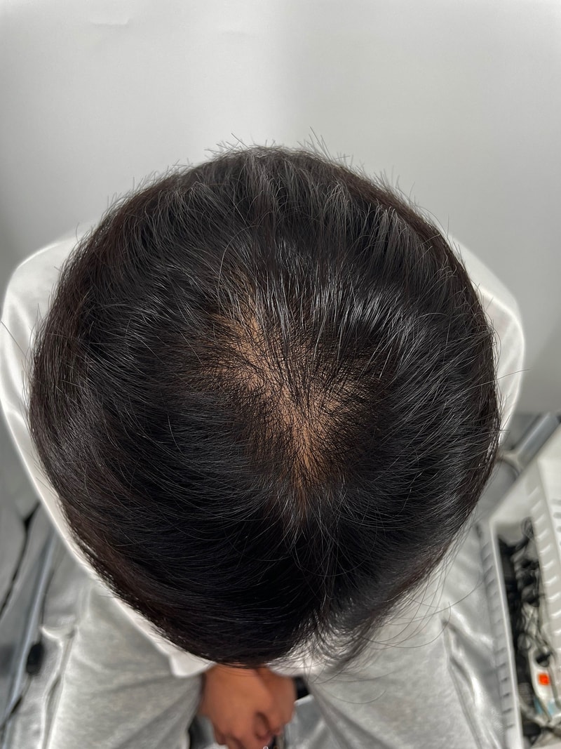 뉴헤어 강남점에서 두피문신 받았습니다