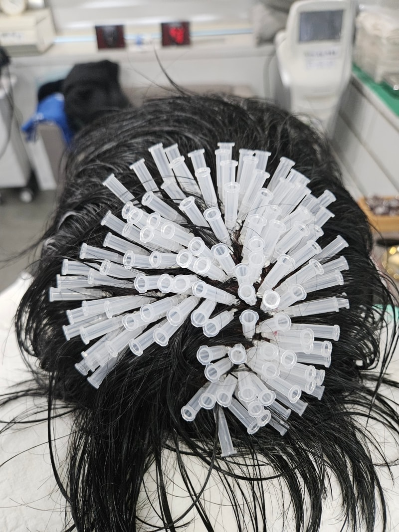 延世美达人_碎发再生术后记