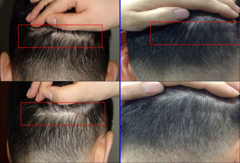 毛发移植切开疤痕部位的头皮纹身后期（两个月后）