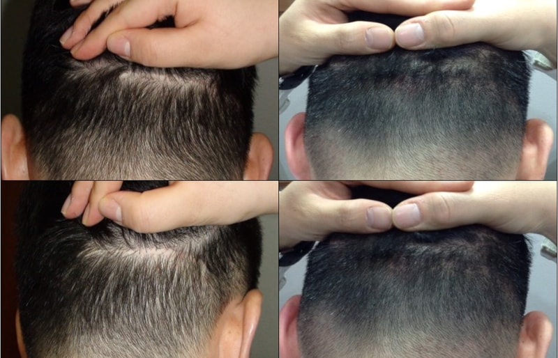 모발이식 절개상처 부위하고 정수리 부분 두피문신했습니다.