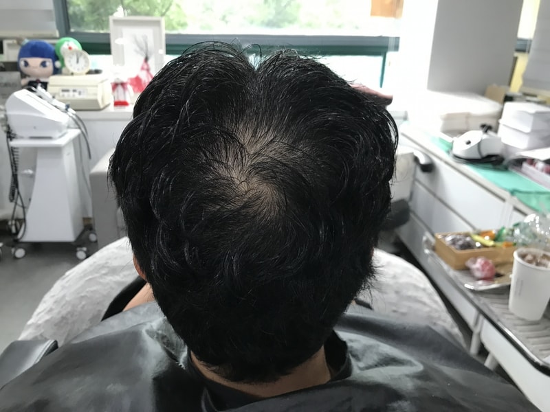 It's a review of scalp tattoos.