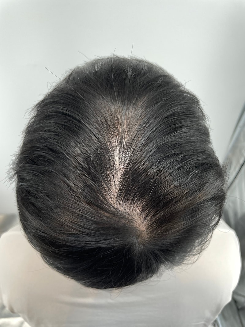 뉴헤어 정수리 두피문신 2회차