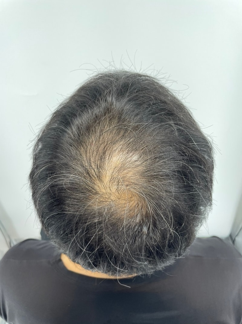 ニューヘアソウル店で頭頂部の頭皮を刺されました。