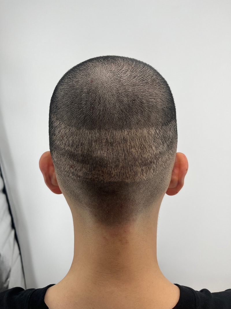 毛发移植遮盖疤痕头皮纹身后记（New Hair 首尔店）