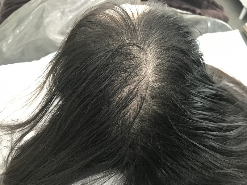 为什么现在才纹头皮呢