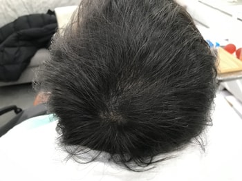 두달후 리터치 하기전